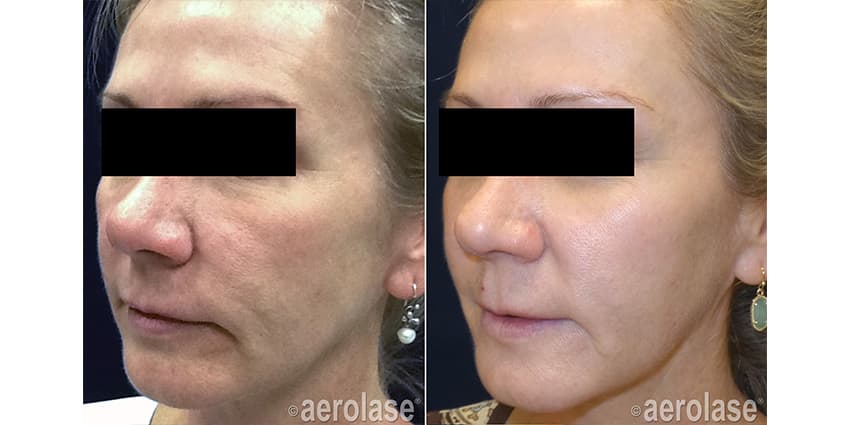 NeoSkin Rejuvenation - After 4 Treatments - Kevin Pinski MD