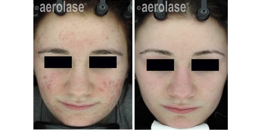 NeoClear Acne - 3 Months After 5 Treatments - David Goldberg MD