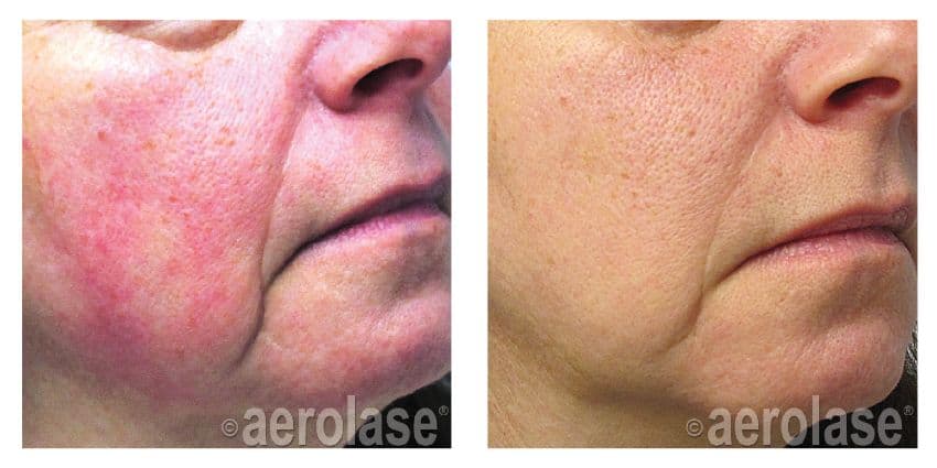 NeoSkin Rosacea - After 1 Treatment - Yelena Kipervas DO