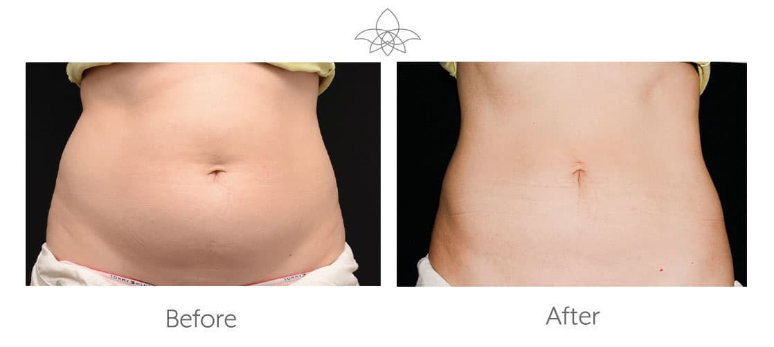 CoolSculpting before and after