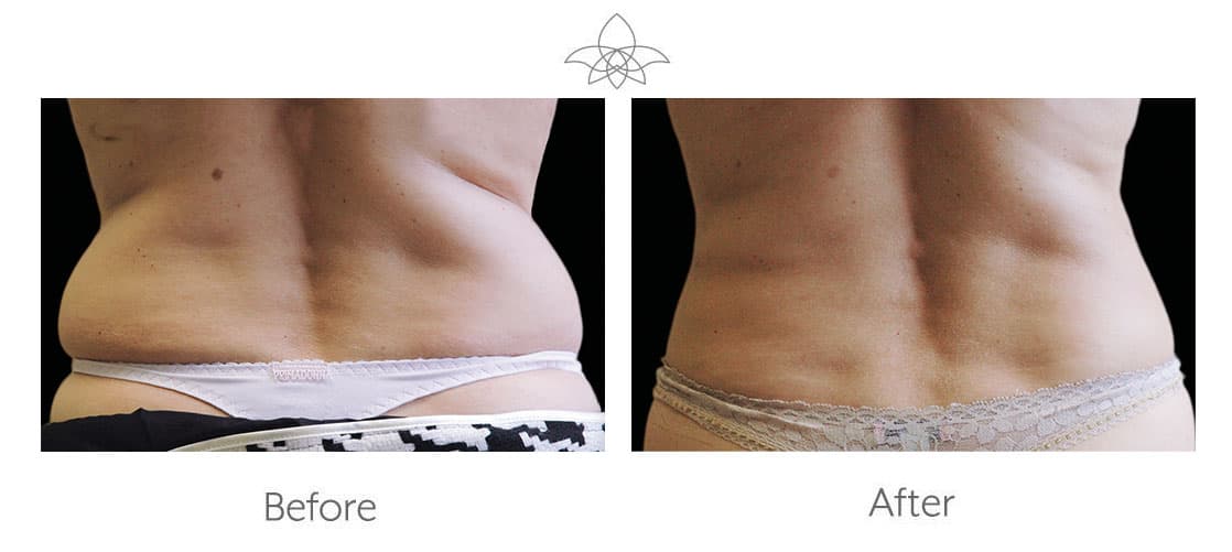 CoolSculpting before and after