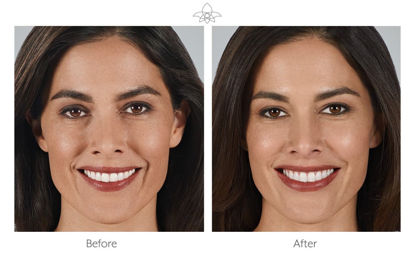 JUVÉDERM® before and after