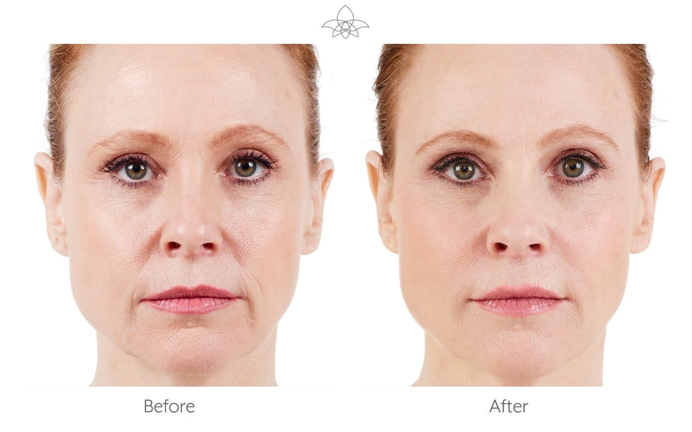 JUVÉDERM® before and after