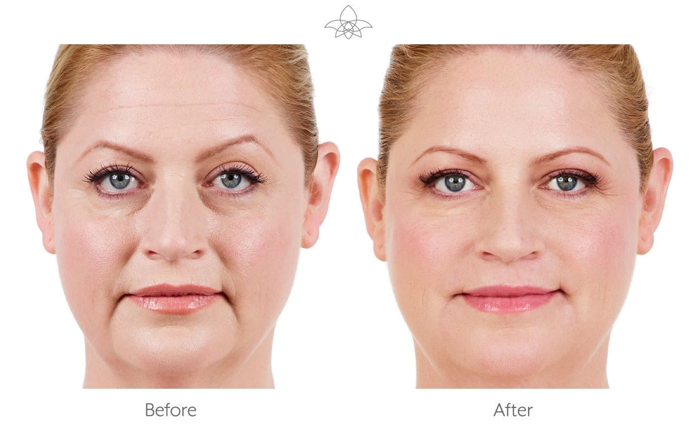 JUVÉDERM® before and after