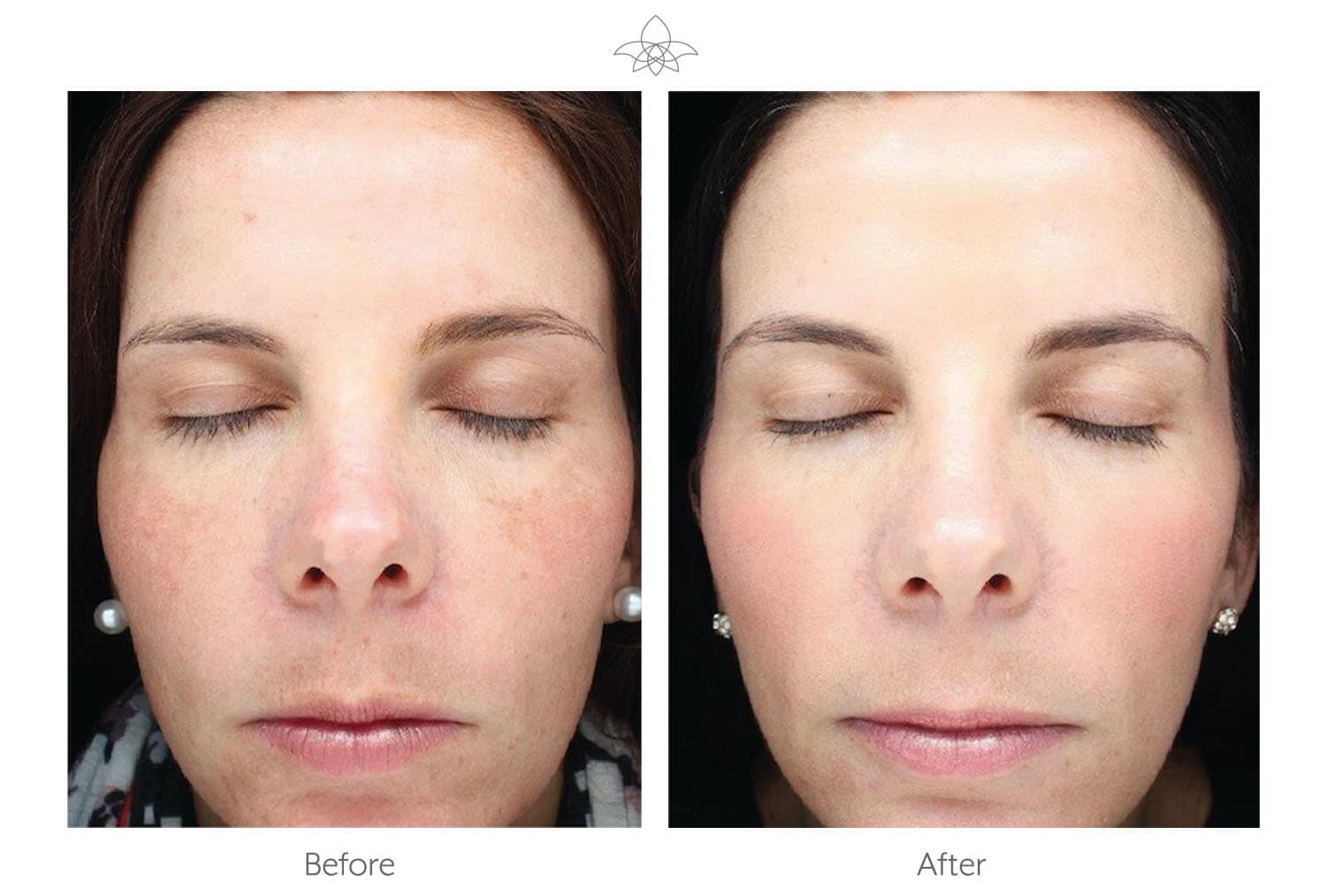 Halo Laser Skin Resurfacing