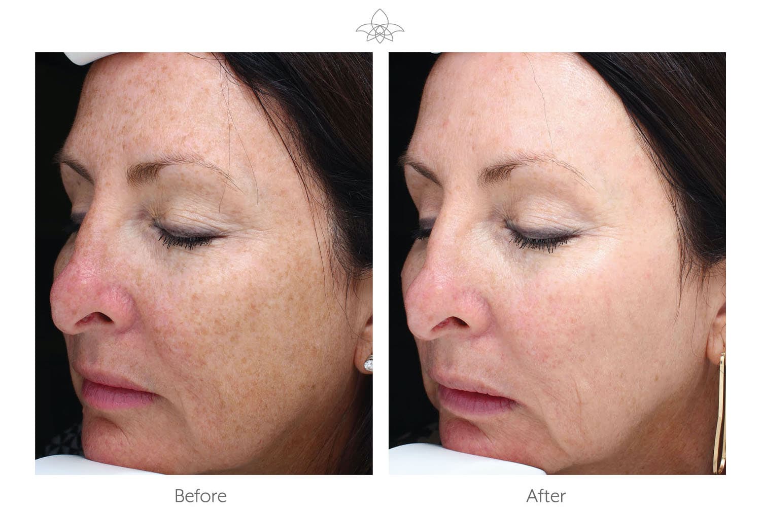 Halo Laser Skin Resurfacing