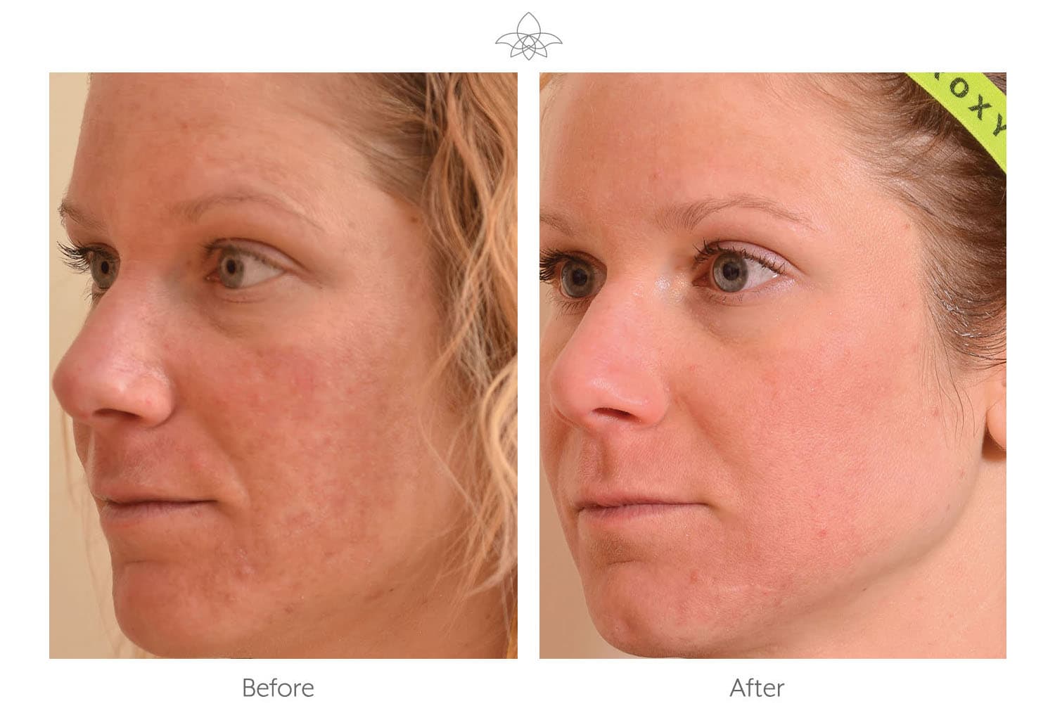 Halo Laser Skin Resurfacing