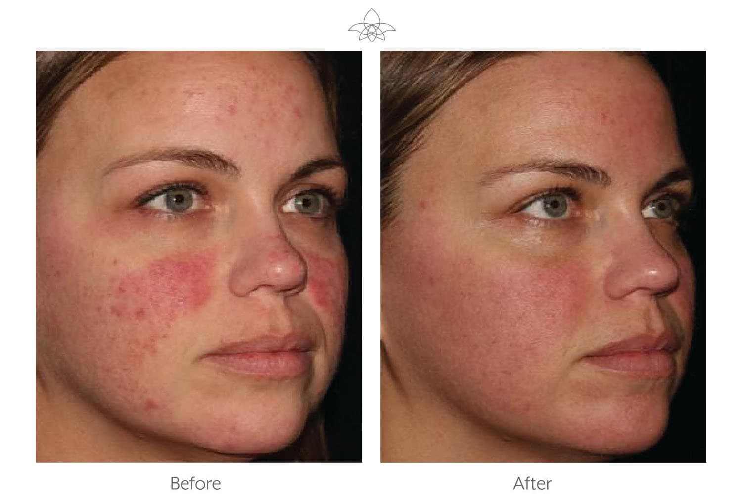 Halo Laser Skin Resurfacing