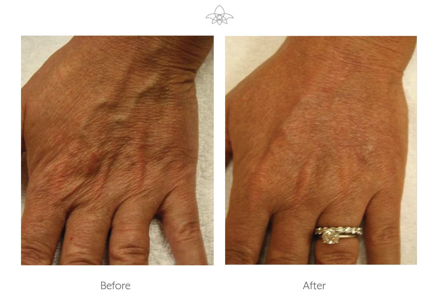 Halo Laser Skin Resurfacing