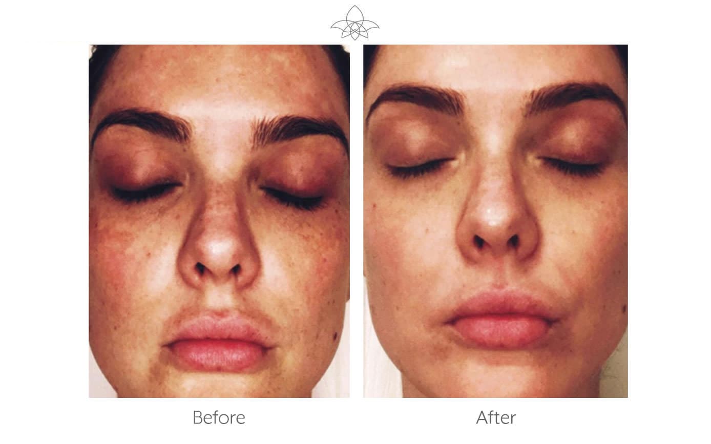 Before and after melasma treatment