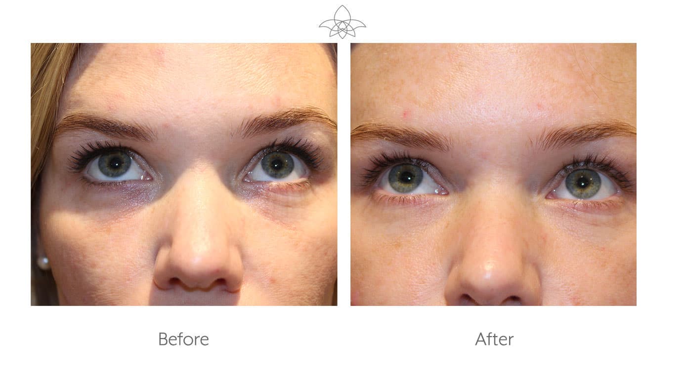 PRF Filler Before and After 01