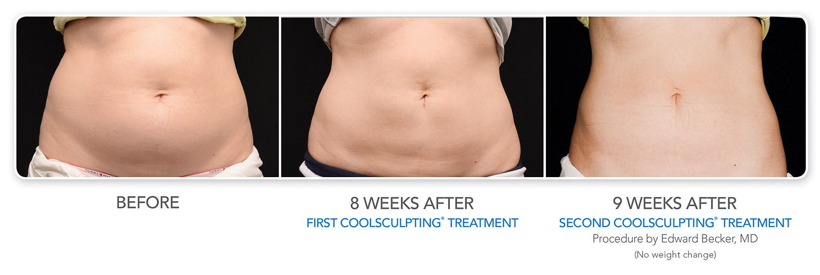Three photos showing a patient's abdomen before, 8 weeks after 1 treatment, and 9 weeks after 2 CoolSculpting treatments