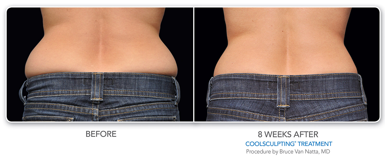 Close-up of woman's lower back and flanks before and 8 weeks after CoolSculpting treatment