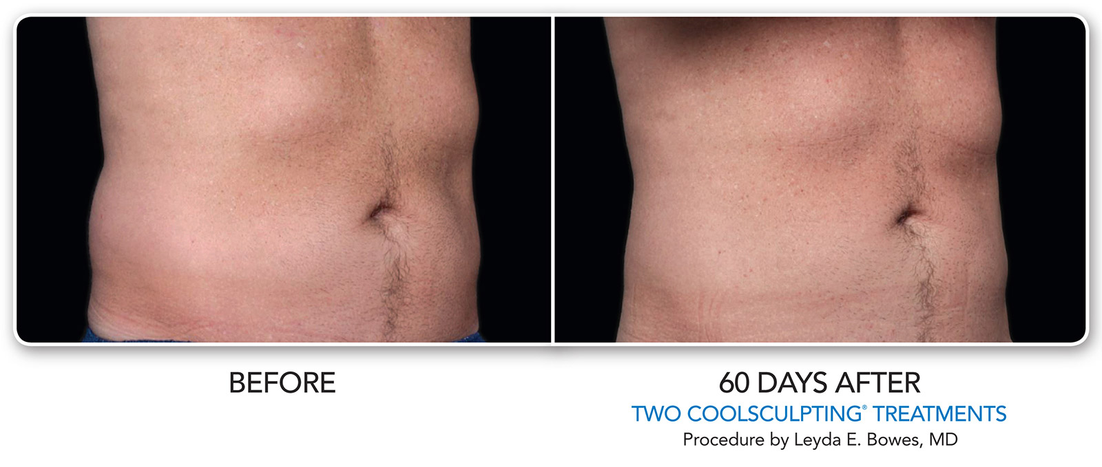 Close-up of man's abdomen before and 60 days after 2 CoolSculpting treatments