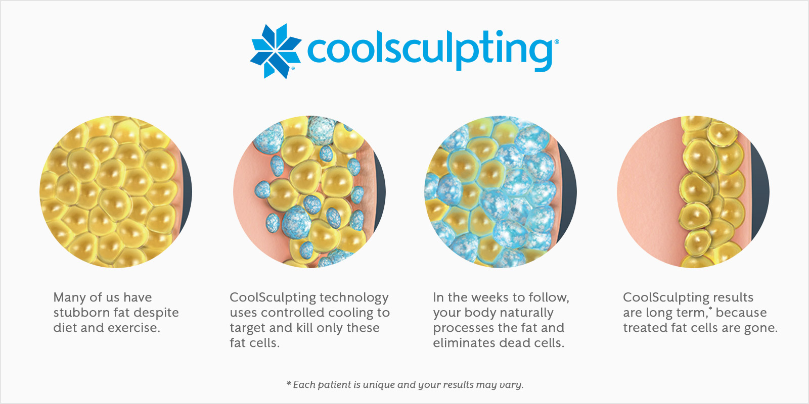 An illustration of fat cells and how they respond to CoolSculpting's cryolipolysis