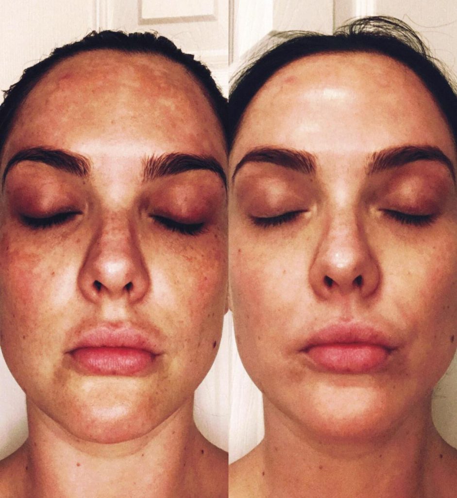 Complexion Correction MD Peel Before and After 2