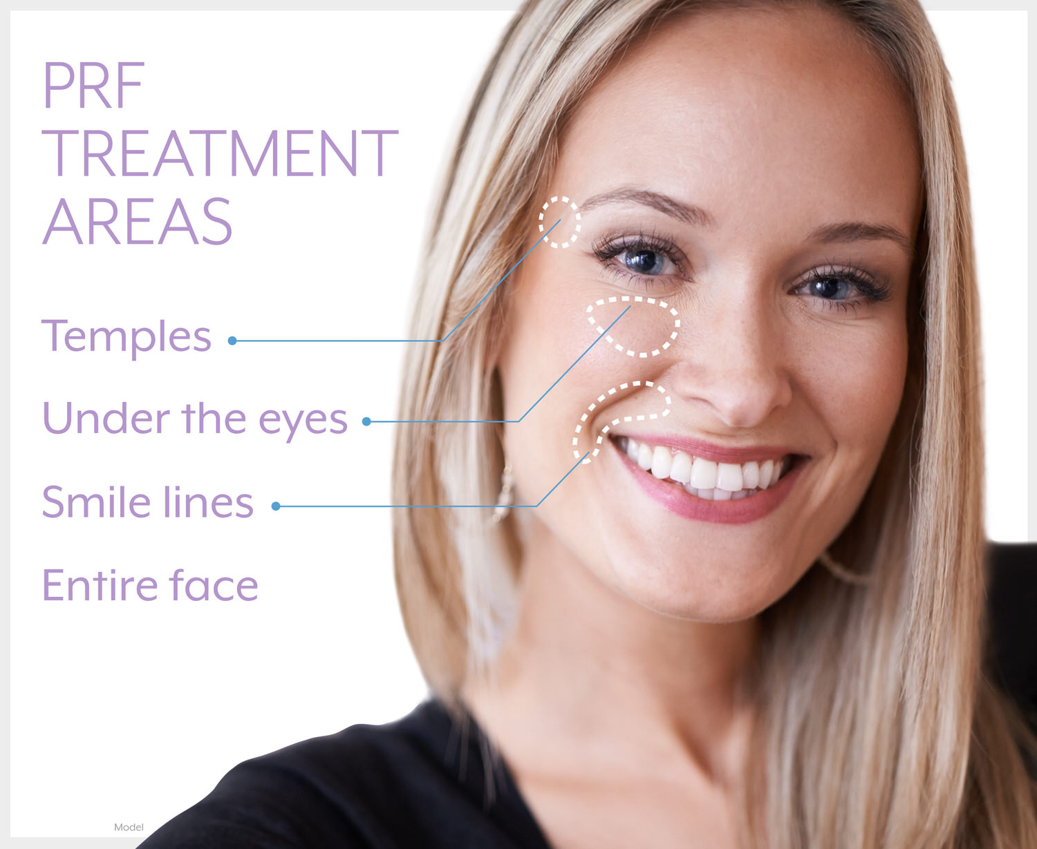 PRF treatment areas on the temples, under the eyes, smile lines, and entire face.