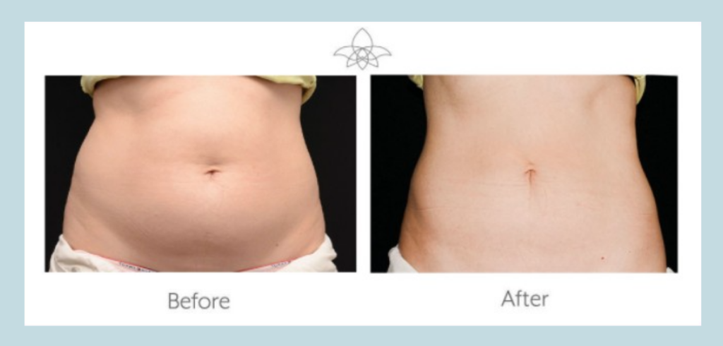 Before-and-after CoolSculpting Elite