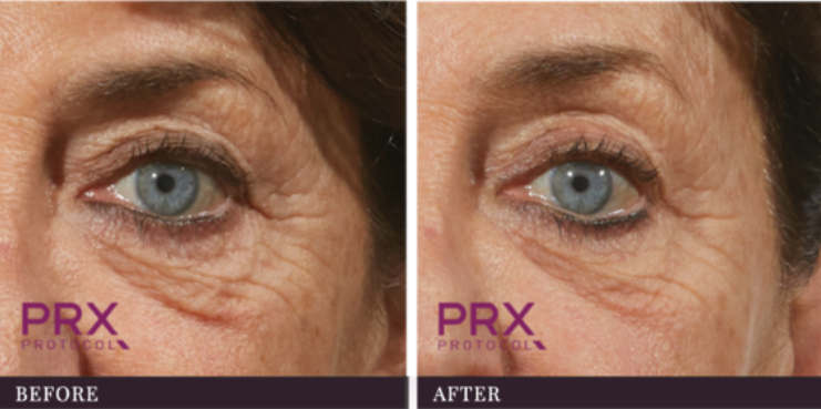 woman's face before and after PRX-T33 treatment