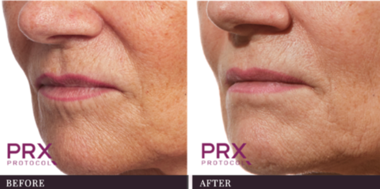 woman's mouth area before and after PRX-T33 treatment