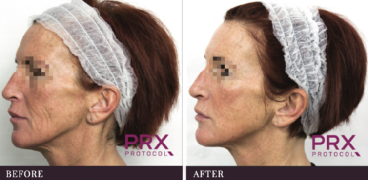 side profile of woman's face before and after PRX-T33 treatment