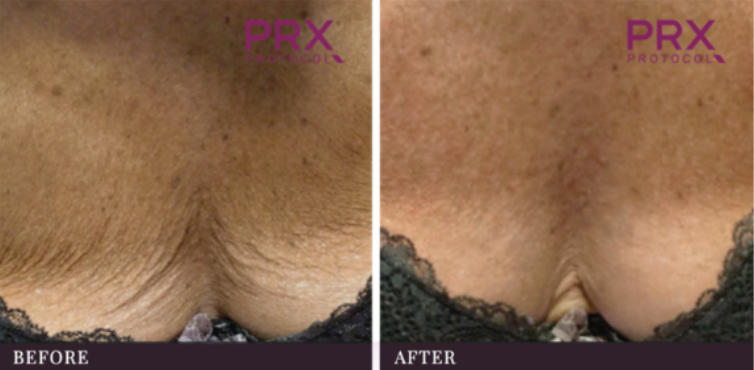woman's chest area before and after PRX-T33 treatment