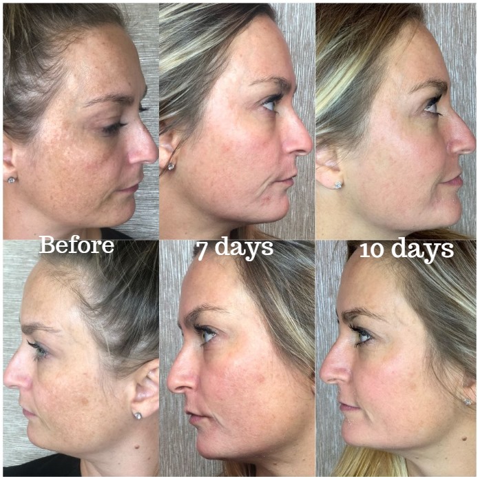 Complexion Correction MD Peel before and after