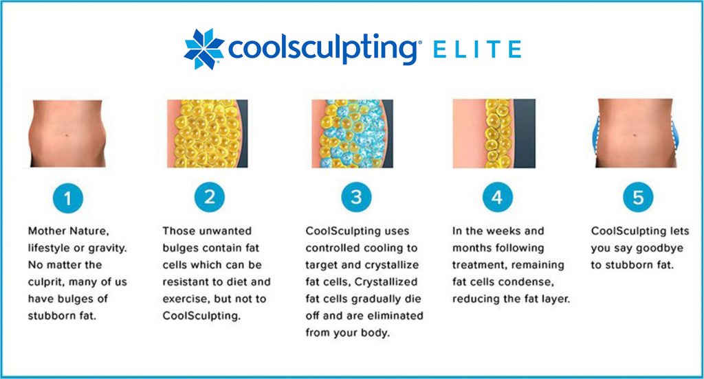 Coolsculpting Elite diagram