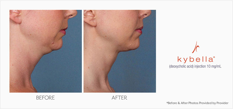 womans side profile before and after kybella injections in chin