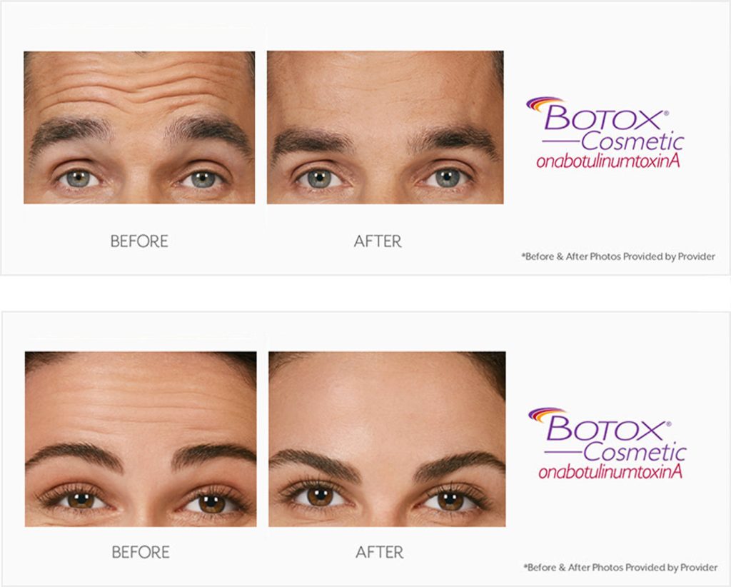 man and womans forehead before and after botox