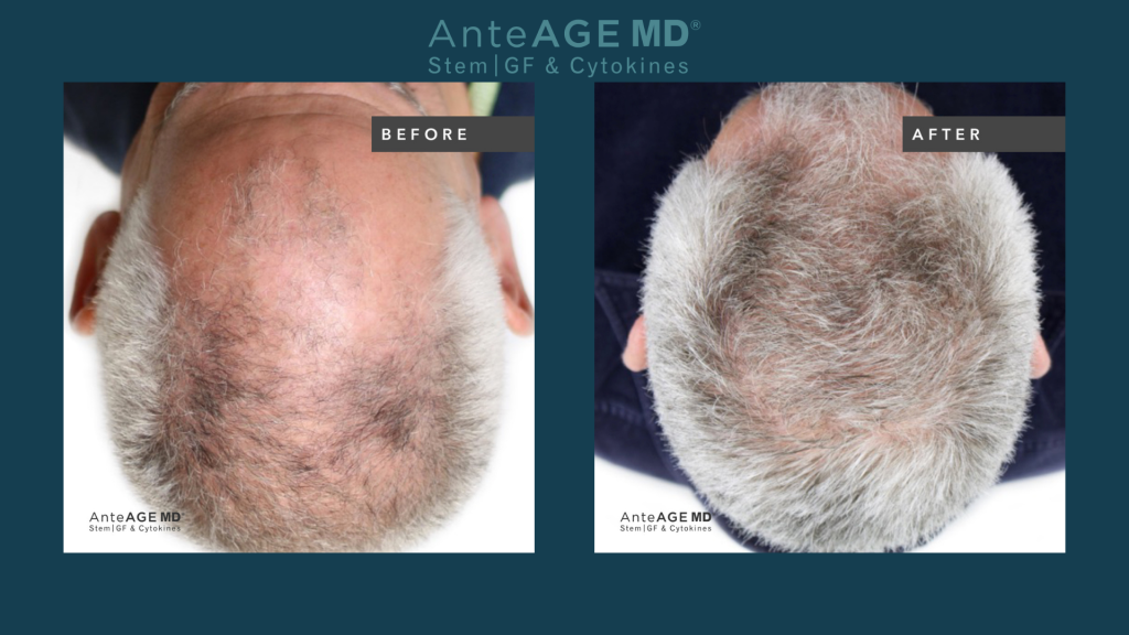 AnteAGE MD before-and-after real patient results