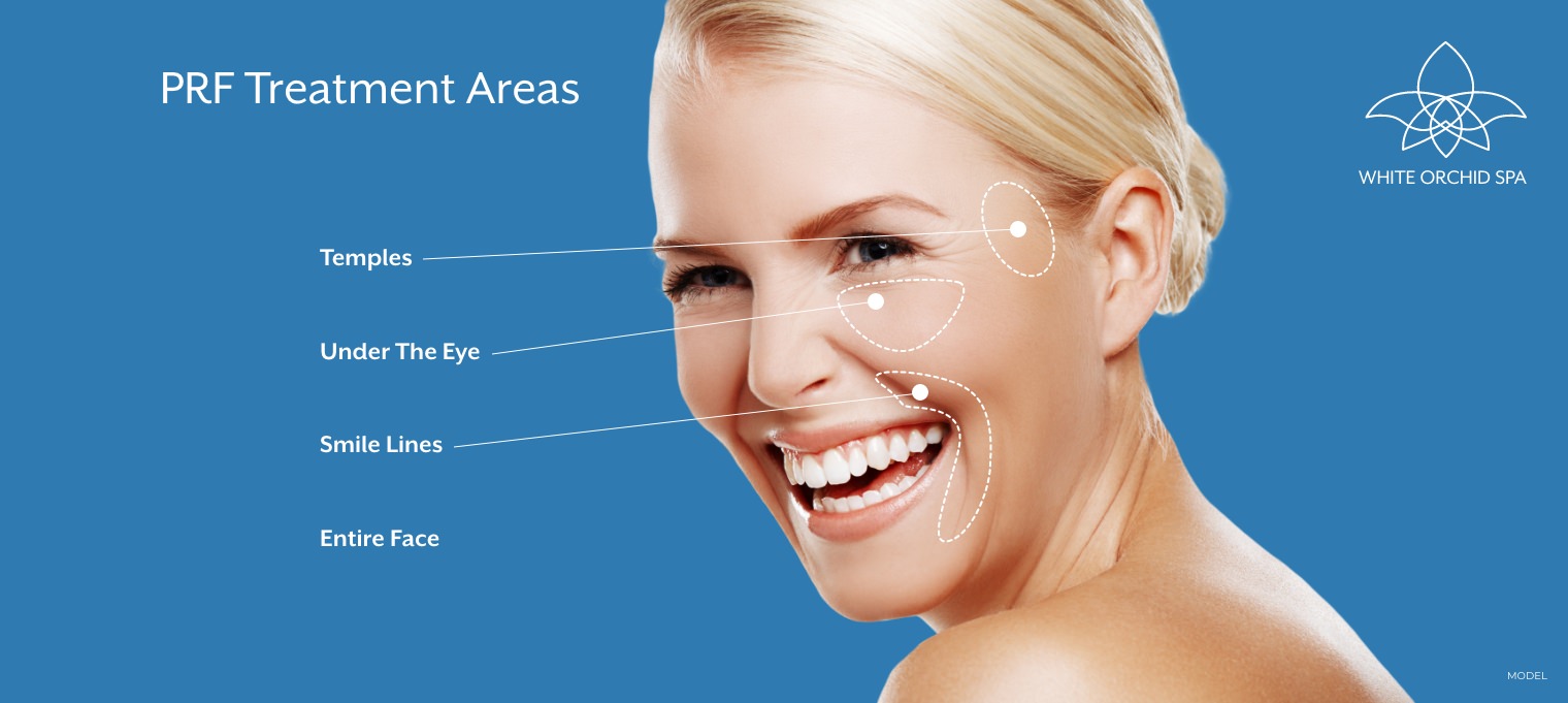 PRF treatment areas include the temples, under eye, smile lines, and entire face