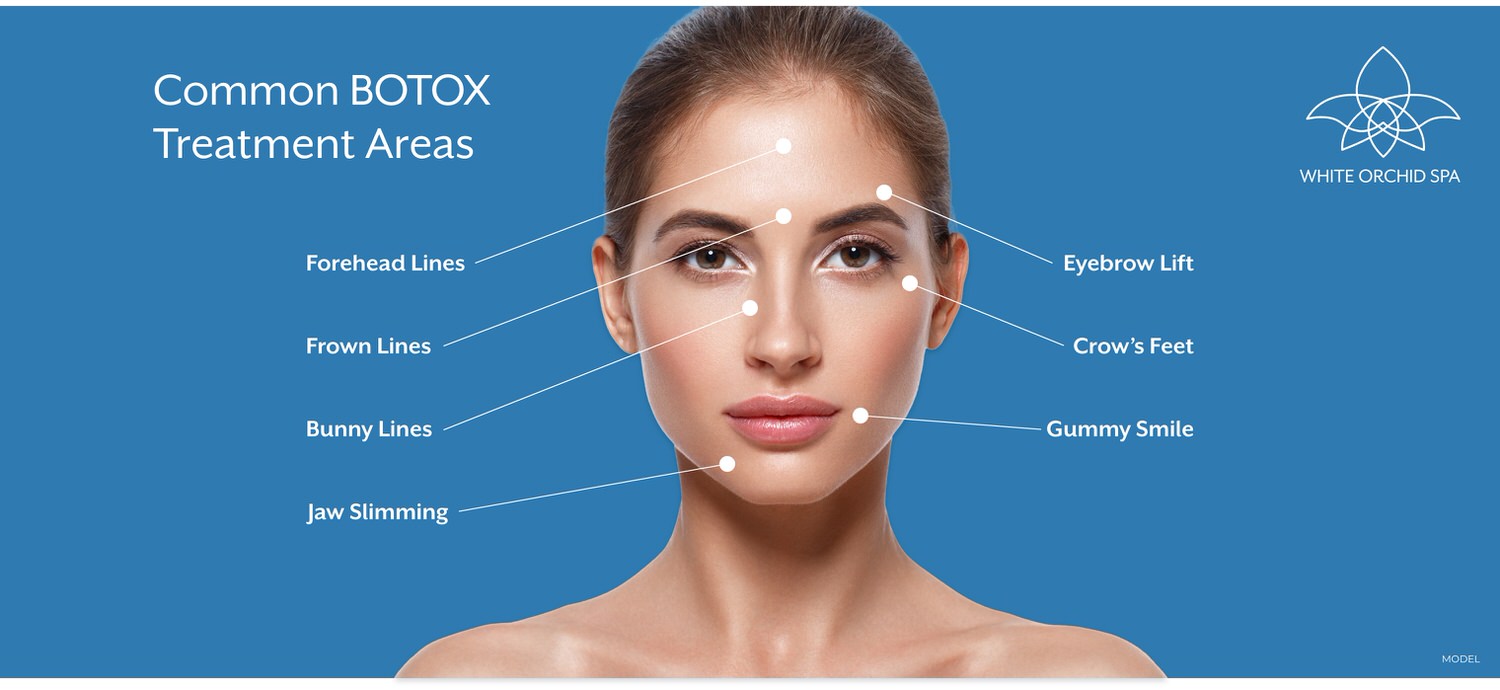 Common BOTOX treatment areas include forehead lines, frownlines, bunny lines, jaw slimming, eyebrow lift, crow's feet, and gummy smile
