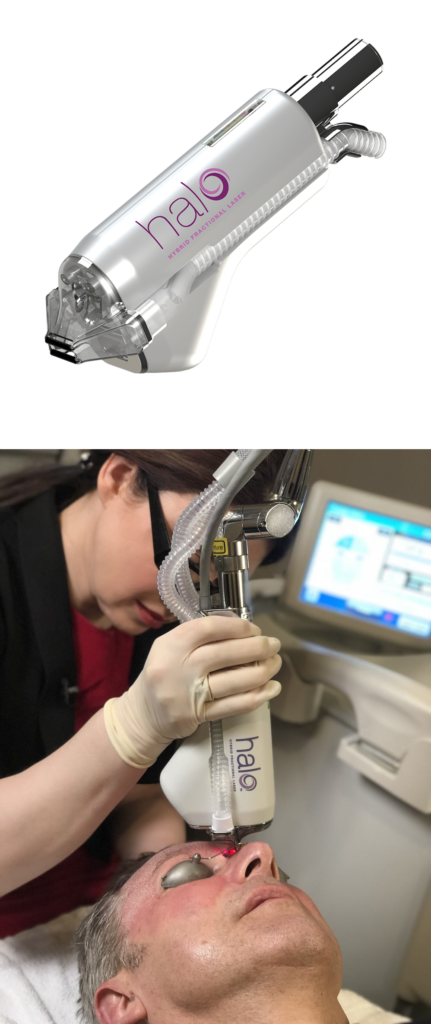 HALO™ Laser Skin Resurfacing machine being used on patient
