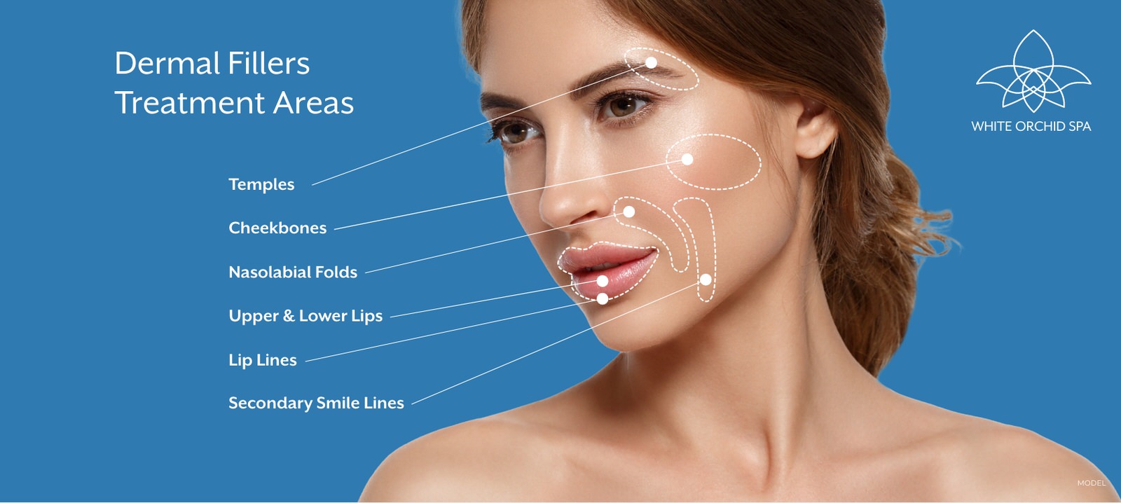 Dermal fillers treatment areas include the temples, cheekbones, nasolabial folds, upper & lower lips, lip lines, and secondary smile lines