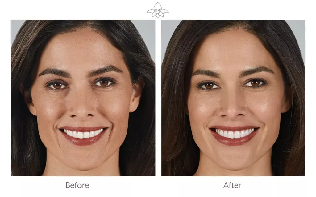 Smiling brunette woman before and after dermal fillers