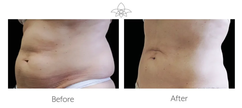 Abdominal area before and after CoolSculpting